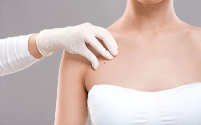 Regular Skin Cancer Checks Help With Early Detection